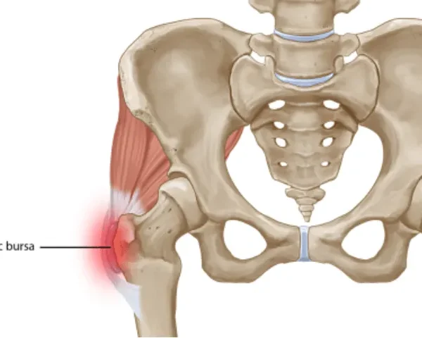 Bursite trocantérica